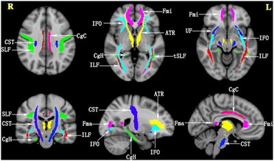 White Matter Microstructural Damage as an Early Sign of Subjective Cognitive Decline